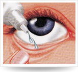 將藥液滴入眼內，切勿滴管開口或手指接觸到眼球或眼瞼