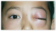 眼球運動障礙和復視