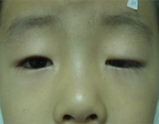 上瞼下垂手術適用人群