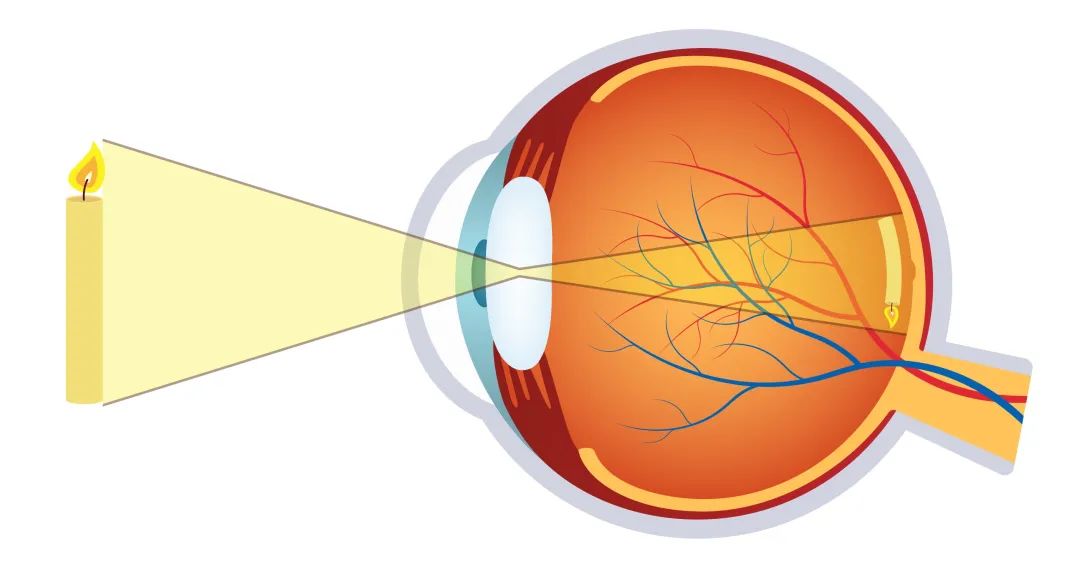 視網膜色素變性